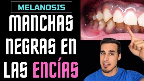 Qué son estas MANCHAS NEGRAS en las ENCÍAS Melanosis gingival