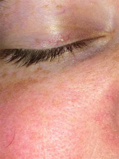 White Bump On Eyelid Eyelid Bumps 101 How To Identify Styes Milia Pimples Allure When This