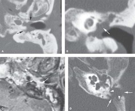 Malignant Tumors Of The External And Middle Ear And Mastoid Radiology Key