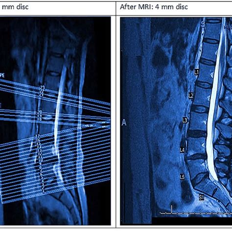 MRI scan before and at the end of the treatment program. | Download Scientific Diagram