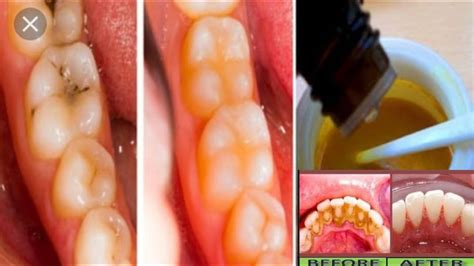 Remove Dental Plague Cavity Yellow Teeth Become White 5 Minute At Home