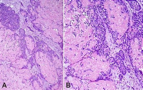 Basaloid Squamous Cell Carcinoma With Shadow Ghost Cell