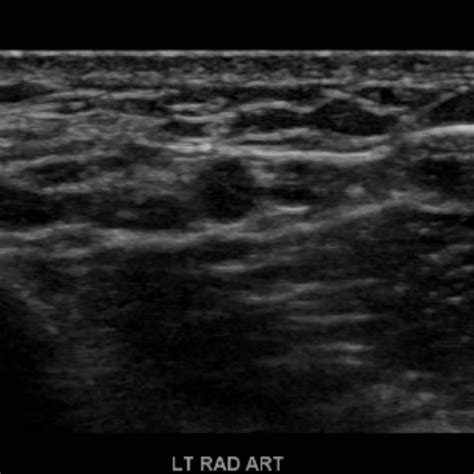 Arterial Duplex/Doppler Sonography of the Upper Extremities ...