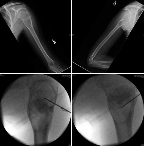 Evidence-Based Treatment of Simple Bone Cyst | Musculoskeletal Key