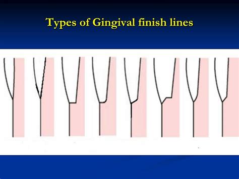 Ppt Margin Finish Line Placement Finish Line Of The Preparation Is