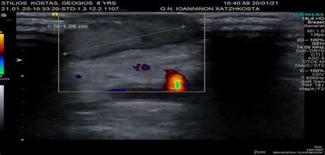 Pseudoaneurysm as depicted preoperatively | Download Scientific Diagram