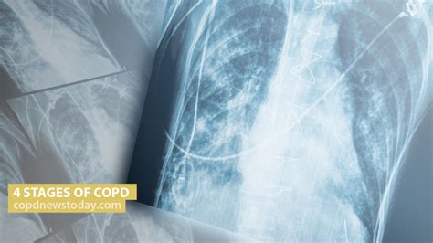 Stages Of Copd Fev