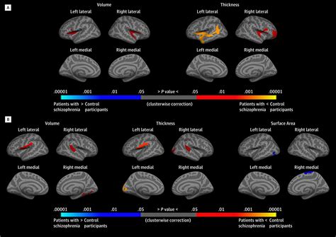 Iq Changes And Progressive Brain Changes In Patients With Schizophrenia