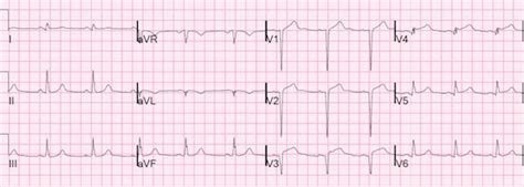 Pv Card Early Repolarization Vs Stemi On Ecg