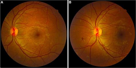 Frontiers Non Mydriatic Fundus Retinography In Screening For Diabetic