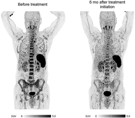 ga pentixafor petct  detection  chemokine receptor cxcr