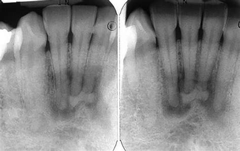 Differential Diagnosis of Periapical Radiopacities and Radiolucencies ...