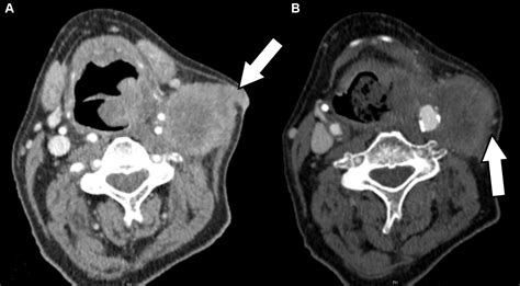 Radiological Assessment Of Extranodal Extension In Patients With Head