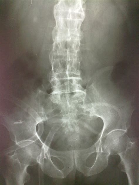 Bamboo spine - Ankylosing spondilitis - Radiology