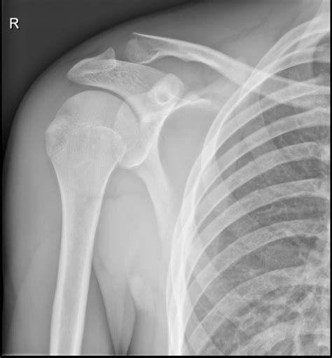 Broken Right Clavicle