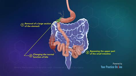 Biliary Pancreatic Diversion With Duodenal Switch Surgery Video