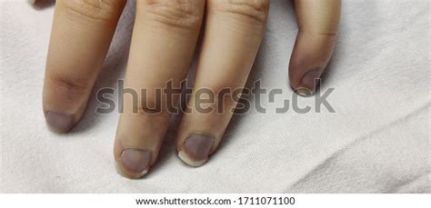 4 Acrocyanosis Images, Stock Photos, 3D objects, & Vectors | Shutterstock