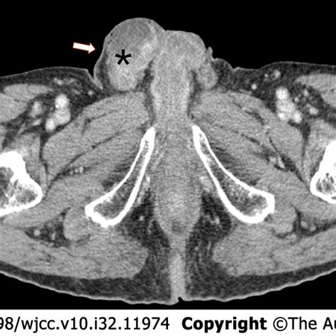 Computed Tomography Urography Image Showing A Mixed Solid Cystic Mass