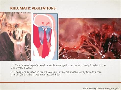 Pathology Of Rheumatic Heart Disease Infective Endocarditis And