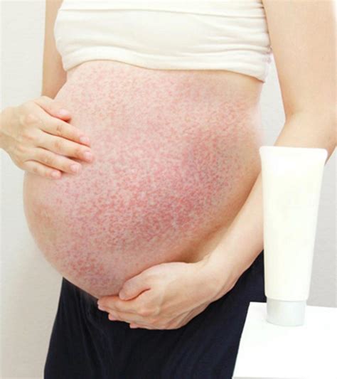 Pregnancy Bumps On Skin Puppp Rash In Pregnancy Prevention Treatment