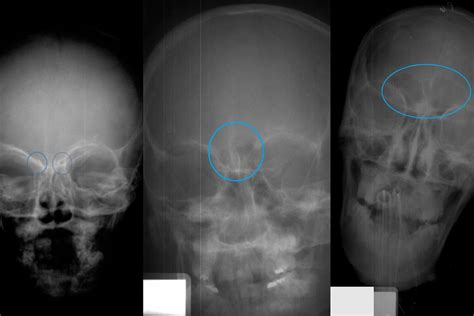 Frontal Sinus Xray