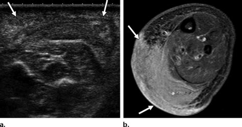 Kaposiform Hemangioendothelioma In A 2 Week Old Boy With A Purple Calf