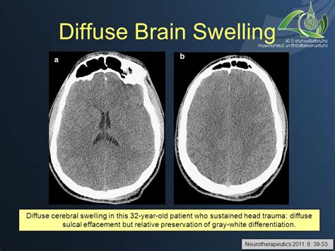 Brain Feels Swollen Cerebral Edema Brain Swelling Symptoms Causes And Treatment