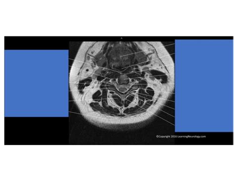 MRI cervical spine Axial view Quiz