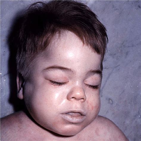 Medical Pictures Info Hurler Syndrome