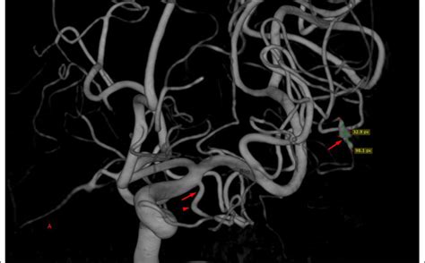 3D DSA Of Left Internal Carotid Artery LICA Determined The Size Of