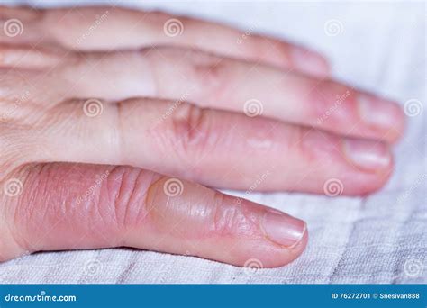 Scalded Hand Blister On Your Finger Stock Image Image Of Blister