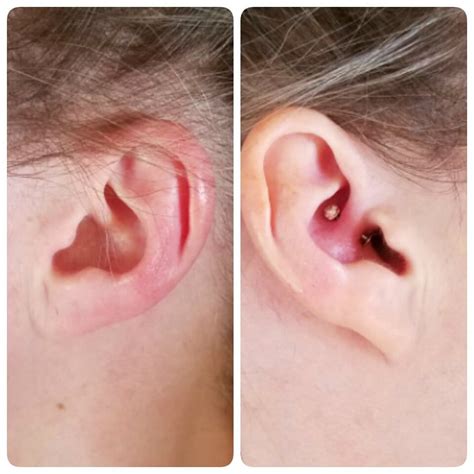 Migraine Piercing 1 Year Results Migraine Piercing Piercing For Migraine Relief Ear