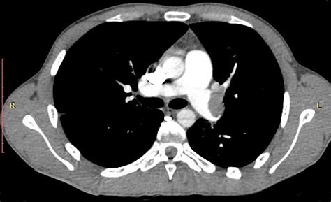 Preopoperative Ct Angiography Showing Massive Lpa Embolism With Small