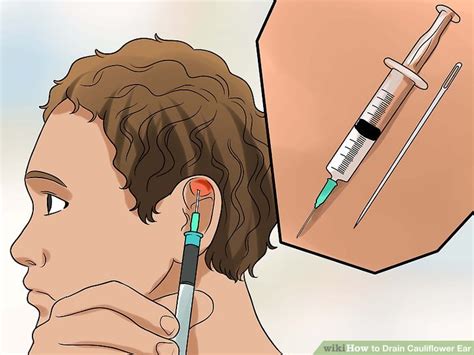 3 Ways to Drain Cauliflower Ear - wikiHow