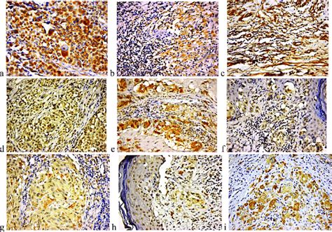 timp  timp   timp  dab detection  melanoma