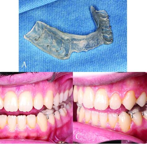 A B Anterior Repositioning Splint C Frontal View Of The Anterior