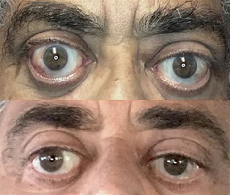 Chronic Thyroid Eye Disease Before And After Tepezza Teprotumumab Trbw