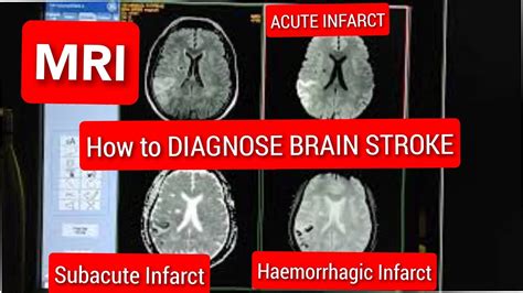 Brain Stroke Diagnosis Acute Infarct Subacute Infarct Hemorrhagic Infarct On Mri Youtube