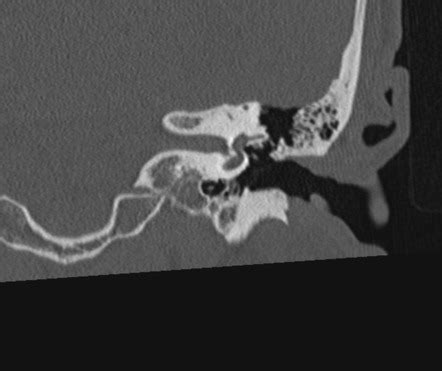 Cystic Acoustic Schwannoma Image Radiopaedia Org