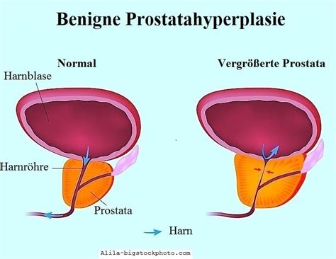 Chronische Oder Akute Prostatitis Symptome Und Behandlung