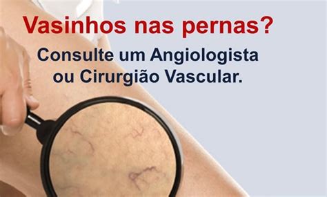 Vasinhos nas Pernas Angiologia Clínica e Cirurgia Vascular