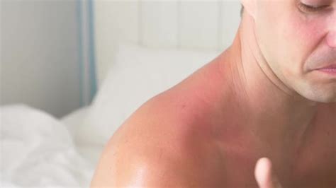 4k A Man Smears His Shoulders Received A Sunburn Gel From Burns A