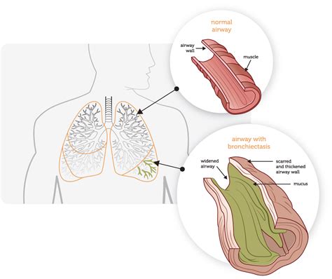 Pathophysiology Bronchiectasis