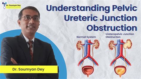 Puj Obstruction Pelvic Ureteric Junction Obstruction Understanding And Treatment Options Dr