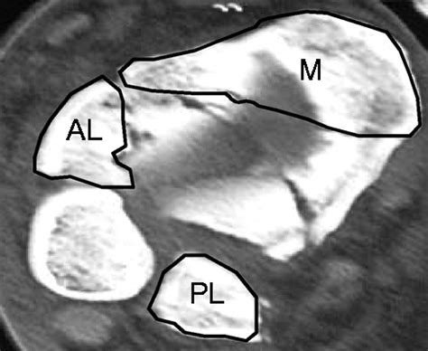 Anatomy Of Pilon Fractures Of The Distal Tibia Bone And Joint