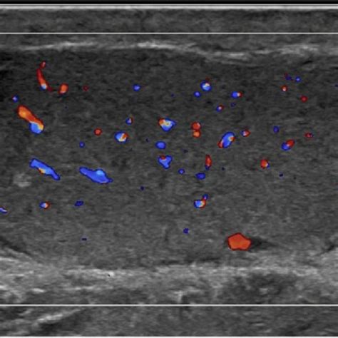Scrotal Anatomy Ultrasound