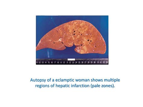 Ppt Hepatic Dysfunction During Pregnancy Powerpoint Presentation