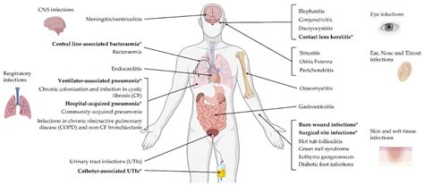 Pseudomonas Aeruginosa Burn Infection