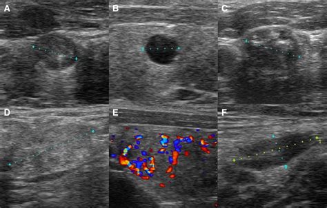 Efficacy Of Surgeon Performed Ultrasound Guided Lymph Node Fine Needle