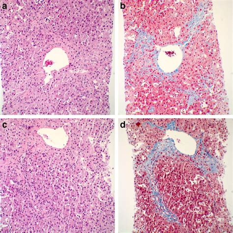 A 20 Year Old Man With Fontan Associated Liver Disease A B Liver Download Scientific Diagram